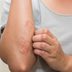 Is It Eczema or Something Else? 5 Clear Signs to Never Ignore