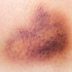 The Real Reason You Bruise So Easily