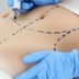 This Cosmetic Procedure Just Overtook Breast Augmentation As #1 in America