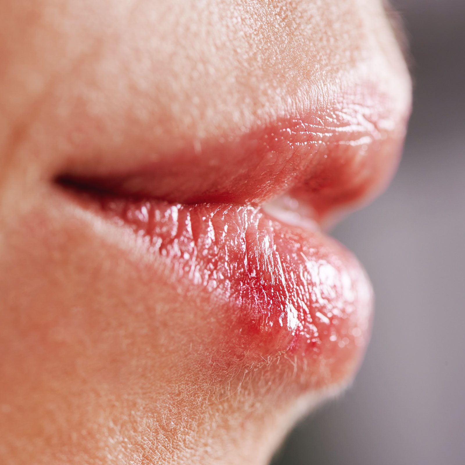 Sunburned Lips? Here’s What Doctors Say You Should Do