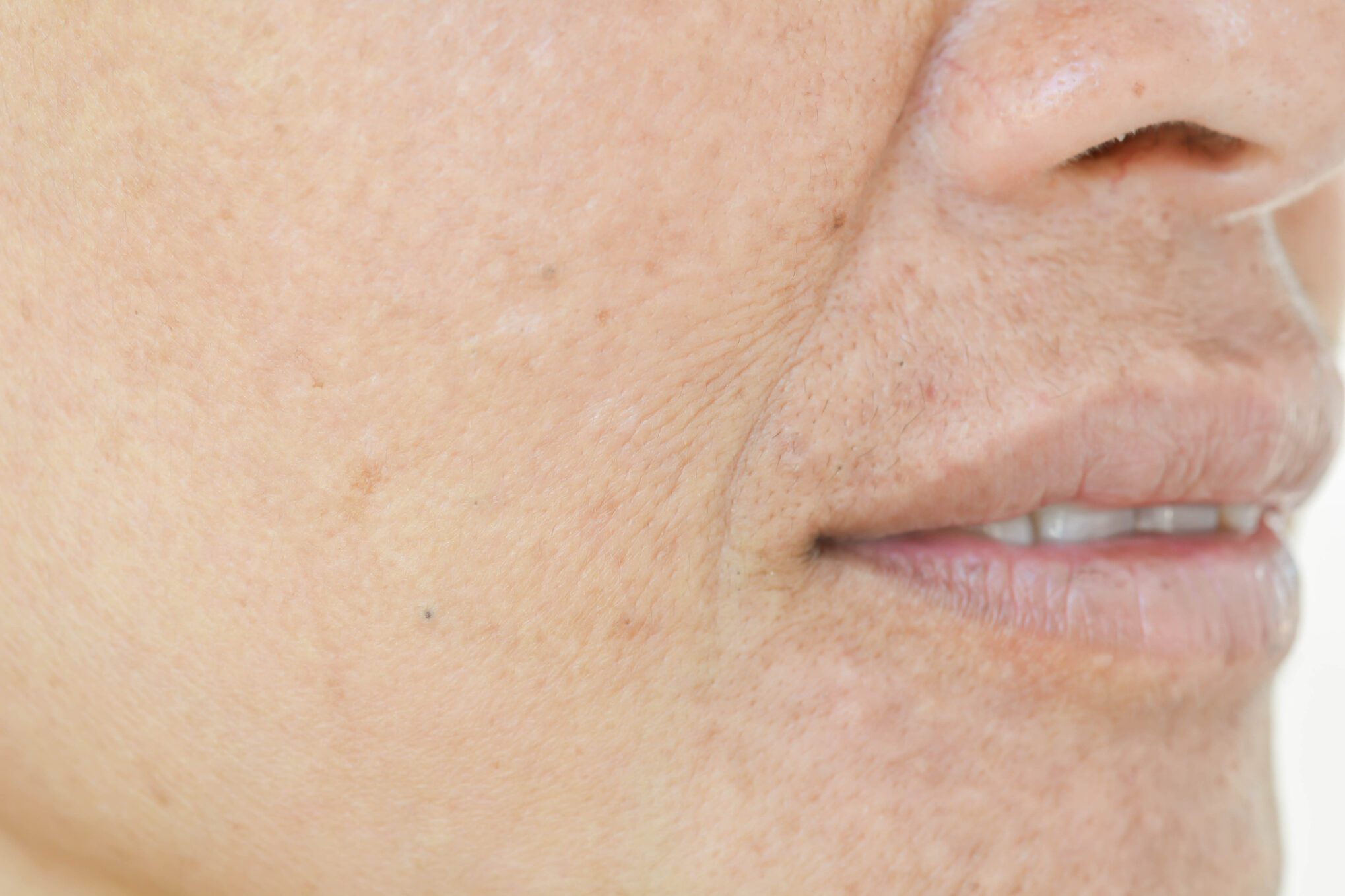 What Is Ozempic Face? 2 Expert Doctors Explain Semaglutide Facial Changes